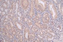 IHC image of RAC07400 diluted at 1:100 and staining in paraffin-embedded human gastric cancer performed on a Leica BondTM system. After dewaxing and hydration, antigen retrieval was mediated by high pressure in a citrate buffer (pH 6.0). Section was blocked with 10% normal goat serum 30min at RT. Then primary antibody (1% BSA) was incubated at 4°C overnight. The primary is detected by a Goat anti-rabbit polymer IgG labeled by HRP and visualized using 0.06% DAB.