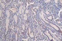 IHC image of RAC07401 diluted at 1:100 and staining in paraffin-embedded human breast cancer performed on a Leica BondTM system. After dewaxing and hydration, antigen retrieval was mediated by high pressure in a citrate buffer (pH 6.0). Section was blocked with 10% normal goat serum 30min at RT. Then primary antibody (1% BSA) was incubated at 4°C overnight. The primary is detected by a Goat anti-rabbit polymer IgG labeled by HRP and visualized using 0.07% DAB.