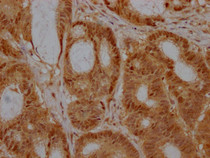 IHC image of RAC07469 diluted at 1:100 and staining in paraffin-embedded human colon cancer performed on a Leica BondTM system. After dewaxing and hydration, antigen retrieval was mediated by high pressure in a citrate buffer (pH 6.0). Section was blocked with 10% normal goat serum 30min at RT. Then primary antibody (1% BSA) was incubated at 4? overnight. The primary is detected by a Goat anti-rabbit IgG polymer labeled by HRP and visualized using 0.05% DAB.