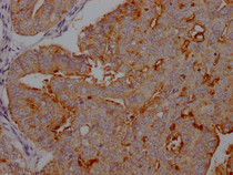 IHC image of RAC07530 diluted at 1:100 and staining in paraffin-embedded human endometrial cancer performed on a Leica BondTM system. After dewaxing and hydration, antigen retrieval was mediated by high pressure in a citrate buffer (pH 6.0). Section was blocked with 10% normal goat serum 30min at RT. Then primary antibody (1% BSA) was incubated at 4? overnight. The primary is detected by a Goat anti-rabbit IgG polymer labeled by HRP and visualized using 0.05% DAB.