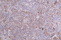 IHC image diluted at 1:100 and staining in paraffin-embedded human ovarian cancer performed on a Leica BondTM system. After dewaxing and hydration, antigen retrieval was mediated by high pressure in a citrate buffer (pH 6.0). Section was blocked with 10% normal goat serum 30min at RT. Then primary antibody (1% BSA) was incubated at 4°C overnight. The primary is detected by a Goat anti-rabbit polymer IgG labeled by HRP and visualized using 0.59% DAB.