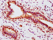 IHC image of RAC07606 diluted at 1:100 and staining in paraffin-embedded human breast cancer performed on a Leica BondTM system. After dewaxing and hydration, antigen retrieval was mediated by high pressure in a citrate buffer (pH 6.0). Section was blocked with 10% normal goat serum 30min at RT. Then primary antibody (1% BSA) was incubated at 4? overnight. The primary is detected by a biotinylated secondary antibody and visualized using an HRP conjugated SP system.