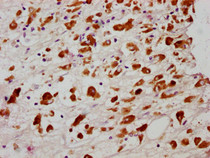 IHC image of RAC07623 diluted at 1:100 and staining in paraffin-embedded human melanoma cancer performed on a Leica BondTM system. After dewaxing and hydration, antigen retrieval was mediated by high pressure in a citrate buffer (pH 6.0). Section was blocked with 10% normal goat serum 30min at RT. Then primary antibody (1% BSA) was incubated at 4? overnight. The primary is detected by a biotinylated secondary antibody and visualized using an HRP conjugated SP system.