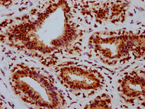 IHC image of RAC07644 diluted at 1:100 and staining in paraffin-embedded human breast cancer performed on a Leica BondTM system. After dewaxing and hydration, antigen retrieval was mediated by high pressure in a citrate buffer (pH 6.0). Section was blocked with 10% normal goat serum 30min at RT. Then primary antibody (1% BSA) was incubated at 4? overnight. The primary is detected by a biotinylated secondary antibody and visualized using an HRP conjugated SP system.