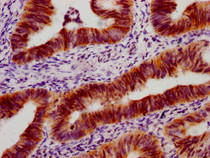 IHC image of RAC07660 diluted at 1:100 and staining in paraffin-embedded human colon cancer performed on a Leica BondTM system. After dewaxing and hydration, antigen retrieval was mediated by high pressure in a citrate buffer (pH 6.0). Section was blocked with 10% normal goat serum 30min at RT. Then primary antibody (1% BSA) was incubated at 4? overnight. The primary is detected by a biotinylated secondary antibody and visualized using an HRP conjugated SP system.