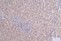 IHC image of RAC07678 diluted at 1:50 and staining in paraffin-embedded human liver cancer performed on a Leica BondTM system. After dewaxing and hydration, antigen retrieval was mediated by high pressure in a citrate buffer (pH 6.0). Section was blocked with 10% normal goat serum 30min at RT. Then primary antibody (1% BSA) was incubated at 4°C overnight. The primary is detected by a Goat anti-rabbit polymer IgG labeled by HRP and visualized using 0.31% DAB.