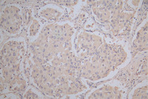 IHC image of RAC07837 diluted at 1:100 and staining in paraffin-embedded human lung cancer performed on a Leica BondTM system. After dewaxing and hydration, antigen retrieval was mediated by high pressure in a citrate buffer (pH 6.0). Section was blocked with 10% normal goat serum 30min at RT. Then primary antibody (1% BSA) was incubated at 4°C overnight. The primary is detected by a Goat anti-Mouse IgG labeled by HRP and visualized using 0.05% DAB.