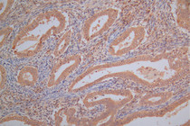 IHC image of RAC07918 diluted at 1:130 and staining in paraffin-embedded human endometrial cancer performed on a Leica BondTM system. After dewaxing and hydration, antigen retrieval was mediated by high pressure in a citrate buffer (pH 6.0). Section was blocked with 10% normal goat serum 30min at RT. Then primary antibody (1% BSA) was incubated at 4°C overnight. The primary is detected by a Goat anti-Mouse IgG labeled by HRP and visualized using 0.05% DAB.