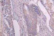 IHC image of RAC08020 diluted at 1：100 and staining in paraffin-embedded human colon cancer performed on a Leica BondTM system. After dewaxing and hydration, antigen retrieval was mediated by high pressure in a citrate buffer (pH 6.0). Section was blocked with 10% normal goat serum 30min at RT. Then primary antibody (1% BSA) was incubated at 4°C overnight. The primary is detected by a Goat anti-human polymer IgG labeled by HRP and visualized using 0.05% DAB.