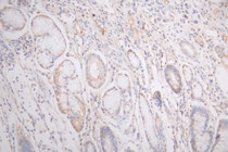 IHC image of RAC08024 diluted at 1:200 and staining in paraffin-embedded human gastric cancer performed on a Leica BondTM system. After dewaxing and hydration, antigen retrieval was mediated by high pressure in a citrate buffer (pH 6.0). Section was blocked with 10% normal goat serum 30min at RT. Then primary antibody (1% BSA) was incubated at 4°C overnight. The primary is detected by a Goat anti-human polymer IgG labeled by HRP and visualized using 0.05% DAB.