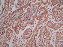 IHC image diluted at 1:50 and staining in paraffin-embedded human endometrial cancer performed on a Leica BondTM system. After dewaxing and hydration, antigen retrieval was mediated by high pressure in a citrate buffer (pH 6.0). Section was blocked with 10% normal goat serum 30min at RT. Then primary antibody (1% BSA) was incubated at 4°C overnight. The primary is detected by a Goat anti-Mouse IgG labeled by HRP and visualized using 0.05% DAB.