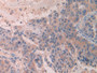 DAB staining on IHC-P; Samples: Human Breast cancer Tissue; Primary Ab: 10µg/ml Rabbit Anti-Human SCUBE3 Antibody Second Ab: 2µg/mL HRP-Linked Caprine Anti-Rabbit IgG Polyclonal Antibody