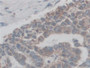 DAB staining on IHC-P; Samples: Human Liver cancer Tissue; Primary Ab: 10µg/ml Rabbit Anti-Human CF6 Antibody Second Ab: 2µg/mL HRP-Linked Caprine Anti-Rabbit IgG Polyclonal Antibody