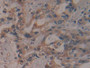 DAB staining on IHC-P; Samples: Human Pancreatic cancer Tissue; Primary Ab: 10µg/ml Rabbit Anti-Human PSMD13 Antibody Second Ab: 2µg/mL HRP-Linked Caprine Anti-Rabbit IgG Polyclonal Antibody