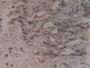 DAB staining on IHC-P; Samples: Human Pancreas Cancer Tissue