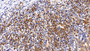 DAB staining on IHC-P; Sample: Human Stomach cancer Tissue; Primary Ab: 10ug/ml Rabbit Anti-Human RGS19 Antibody Second Ab: 2µg/mL HRP-Linked Caprine Anti-Rabbit IgG Polyclonal Antibody