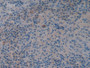 DAB staining on IHC-P; Samples: Human Skin cancer Tissue; Primary Ab: 10µg/ml Rabbit Anti-Human WNT3A Antibody Second Ab: 2µg/mL HRP-Linked Caprine Anti-Rabbit IgG Polyclonal Antibody