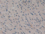 DAB staining on IHC-P; Samples: Human Glioma Tissue; Primary Ab: 10µg/ml Rabbit Anti-Human CARD9 Antibody Second Ab: 2µg/mL HRP-Linked Caprine Anti-Rabbit IgG Polyclonal Antibody