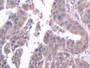 DAB staining on IHC-P; Samples: Human Liver cancer Tissue;  Primary Ab: 20µg/ml Rabbit Anti-Human ST