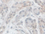 DAB staining on IHC-P; Samples: Human Pancreatic cancer Tissue; Primary Ab: 10µg/ml Rabbit Anti-Human HCRP1 Antibody Second Ab: 2µg/mL HRP-Linked Caprine Anti-Rabbit IgG Polyclonal Antibody