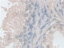 DAB staining on IHC-P; Samples: Human Prostate Tissue; Primary Ab: 10µg/ml Rabbit Anti-Human HCRP1 Antibody Second Ab: 2µg/mL HRP-Linked Caprine Anti-Rabbit IgG Polyclonal Antibody