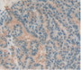 Figure. DAB staining on IHC-P; Samples: Human Thyroid Cancer Tissue.