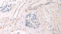 DAB staining on IHC-P; Samples: Human Prostate cancer Tissue; Primary Ab: 20µg/ml Rabbit Anti-Human POTEJ Antibody Second Ab: 2µg/mL HRP-Linked Caprine Anti-Rabbit IgG Polyclonal Antibody