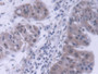 DAB staining on IHC-P; Samples: Human Liver cancer Tissue;  Primary Ab: 20µg/ml Rabbit Anti-Human TF