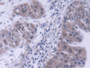 DAB staining on IHC-P; Samples: Human Liver cancer Tissue