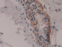 DAB staining on IHC-P; Samples: Human Breast cancer Tissue; Primary Ab: 30µg/ml Rabbit Anti-Human RPS6Ka1 Antibody Second Ab: 2µg/mL HRP-Linked Caprine Anti-Rabbit IgG Polyclonal Antibody