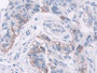 DAB staining on IHC-P; Samples: Human Lung cancer Tissue; Primary Ab: 10µg/ml Rabbit Anti-Human NELL2 Antibody Second Ab: 2µg/mL HRP-Linked Caprine Anti-Rabbit IgG Polyclonal Antibody