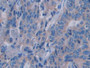 DAB staining on IHC-P; Samples: Human Colorectal cancer Tissue; Primary Ab: 30µg/ml Rabbit Anti-Human SEMA3A Antibody Second Ab: 2µg/mL HRP-Linked Caprine Anti-Rabbit IgG Polyclonal Antibody