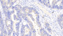 DAB staining on IHC-P; Samples: Human Colorectal cancer Tissue;  Primary Ab: 20μg/ml Rabbit Anti-Human AIMP1 Antibody Second Ab: 2µg/mL HRP-Linked Caprine Anti-Rabbit IgG Polyclonal Antibody 