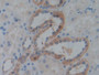 DAB staining on IHC-P; Samples: Human Kidney Tissue; Primary Ab: 10µg/ml Rabbit Anti-Human IGF2BP3 Antibody Second Ab: 2µg/mL HRP-Linked Caprine Anti-Rabbit IgG Polyclonal Antibody