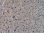 DAB staining on IHC-P; Samples: Human Liver cancer Tissue; Primary Ab: 20µg/ml Rabbit Anti-Human IGF2BP2 Antibody Second Ab: 2µg/mL HRP-Linked Caprine Anti-Rabbit IgG Polyclonal Antibody