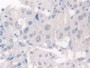 DAB staining on IHC-P; Samples: Human Breast cancer Tissue; Primary Ab: 30µg/ml Rabbit Anti-Human HPS4 Antibody Second Ab: 2µg/mL HRP-Linked Caprine Anti-Rabbit IgG Polyclonal Antibody