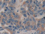 DAB staining on IHC-P; Samples: Human Breast cancer Tissue; Primary Ab: 10µg/ml Rabbit Anti-Human FAM3C Antibody Second Ab: 2µg/mL HRP-Linked Caprine Anti-Rabbit IgG Polyclonal Antibody