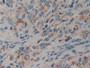 DAB staining on IHC-P; Samples: Human Prostate cancer Tissue; Primary Ab: 10µg/ml Rabbit Anti-Human DVL2 Antibody Second Ab: 2µg/mL HRP-Linked Caprine Anti-Rabbit IgG Polyclonal Antibody