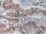 DAB staining on IHC-P; Samples: Mouse Rectum Cancer Tissue