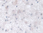 DAB staining on IHC-P; Samples: Human Glioma Tissue; Primary Ab: 30µg/ml Rabbit Anti-Human CCT2 Antibody Second Ab: 2µg/mL HRP-Linked Caprine Anti-Rabbit IgG Polyclonal Antibody