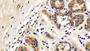 DAB staining on IHC-P; Samples: Human Breast cancer Tissue; Primary Ab: 20ug/ml Rabbit Anti-Mouse Bcl2L2 Antibody Second Ab: 2µg/mL HRP-Linked Caprine Anti-Rabbit IgG Polyclonal Antibody