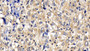 DAB staining on IHC-P; Samples: Human Liver cancer Tissue; Primary Ab: 30ug/ml Rabbit Anti-Human Bcl2L2 Antibody Second Ab: 2µg/mL HRP-Linked Caprine Anti-Rabbit IgG Polyclonal Antibody