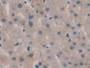 DAB staining on fromalin fixed paraffin- embedded kidney cancer tissue)