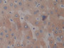 DAB staining on IHC-P; Samples: Human Liver Tissue; Primary Ab: 10µg/ml Rabbit Anti-Human PTX3 Antibody Second Ab: 2µg/mL HRP-Linked Caprine Anti-Rabbit IgG Polyclonal Antibody