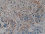 DAB staining on IHC-P; Samples: Human Pancreatic cancer Tissue)