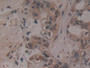 DAB staining on IHC-P; Samples: Human Pancreatic cancer Tissue; Primary Ab: 10µg/ml Rabbit Anti-Human ADAMTS5 Antibody Second Ab: 2µg/mL HRP-Linked Caprine Anti-Rabbit IgG Polyclonal Antibody