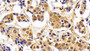 DAB staining on IHC-P; Samples: Human Breast cancer Tissue; Primary Ab: 10μg/ml Rabbit Anti-Human RAD50 Antibody Second Ab: 2µg/mL HRP-Linked Caprine Anti-Rabbit IgG Polyclonal Antibody