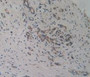 DAB staining on IHC-P; Samples: Human Pancreas Cancer Tissue.