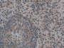 DAB staining on IHC-P; Samples: Human Skin cancer Tissue; Primary Ab: 10µg/ml Rabbit Anti-Human GLG1 Antibody Second Ab: 2µg/mL HRP-Linked Caprine Anti-Rabbit IgG Polyclonal Antibody