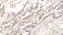 DAB staining on IHC-P; Samples: Human Lung cancer Tissue; Primary Ab: 10µg/ml Rabbit Anti-Human ACO1 Antibody Second Ab: 2µg/mL HRP-Linked Caprine Anti-Rabbit IgG Polyclonal Antibody